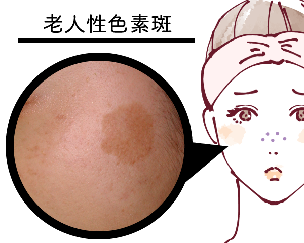 老人性色素斑