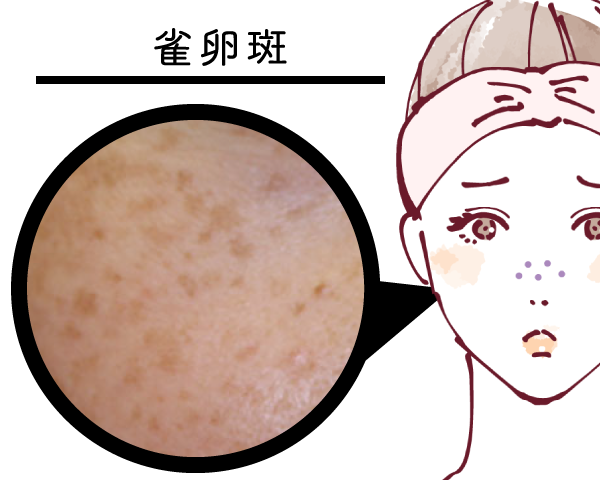 雀卵斑 