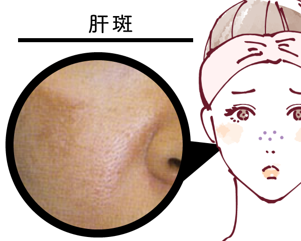 肝斑