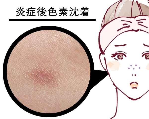 炎症後色素沈着