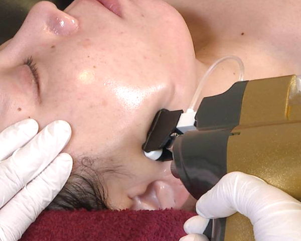 シミ消しにおすすめ施術メニュー